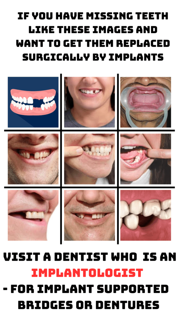 The image contains a collage of 9 pictures in the centre of oral cavities with missing teeth.The text " If you have missing teeth like these images and want to get them replaced surgically by implants" is written on top while the text "  visit a Dentist who is an MDS Implantologist 
- For implant supported  bridges or dentures" is written below the collage.The background is white.