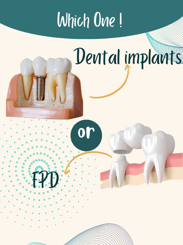 DENTAL IMPLANT OR FPD : WHICH IS THE BEST OPTION.