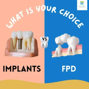 The image shows two options commonly used for replacement of missing teeth .Left side of the image shows a picture of a dental implant and the right side shows an FPD.The text "What is your choice: Implant vs FPD" is written in bold on a pink and blue background.