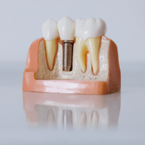 A cross section image of a dental implant in the jaw.