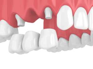 Fixed partial denture on upper teeth is shown in the image .They have lower survival rates when we compare implant vs fpd.