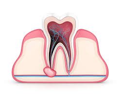 Dental infections can cause bad breath problem