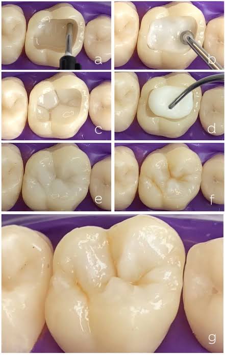 This image shows the placement method of composite fillings which are one of the best tooth filling material.