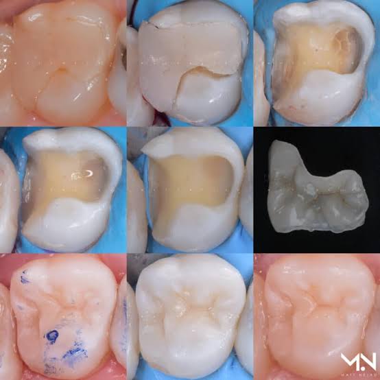 Method of placement of ceramic filling materials which are the most natural looking and best tooth filling material.