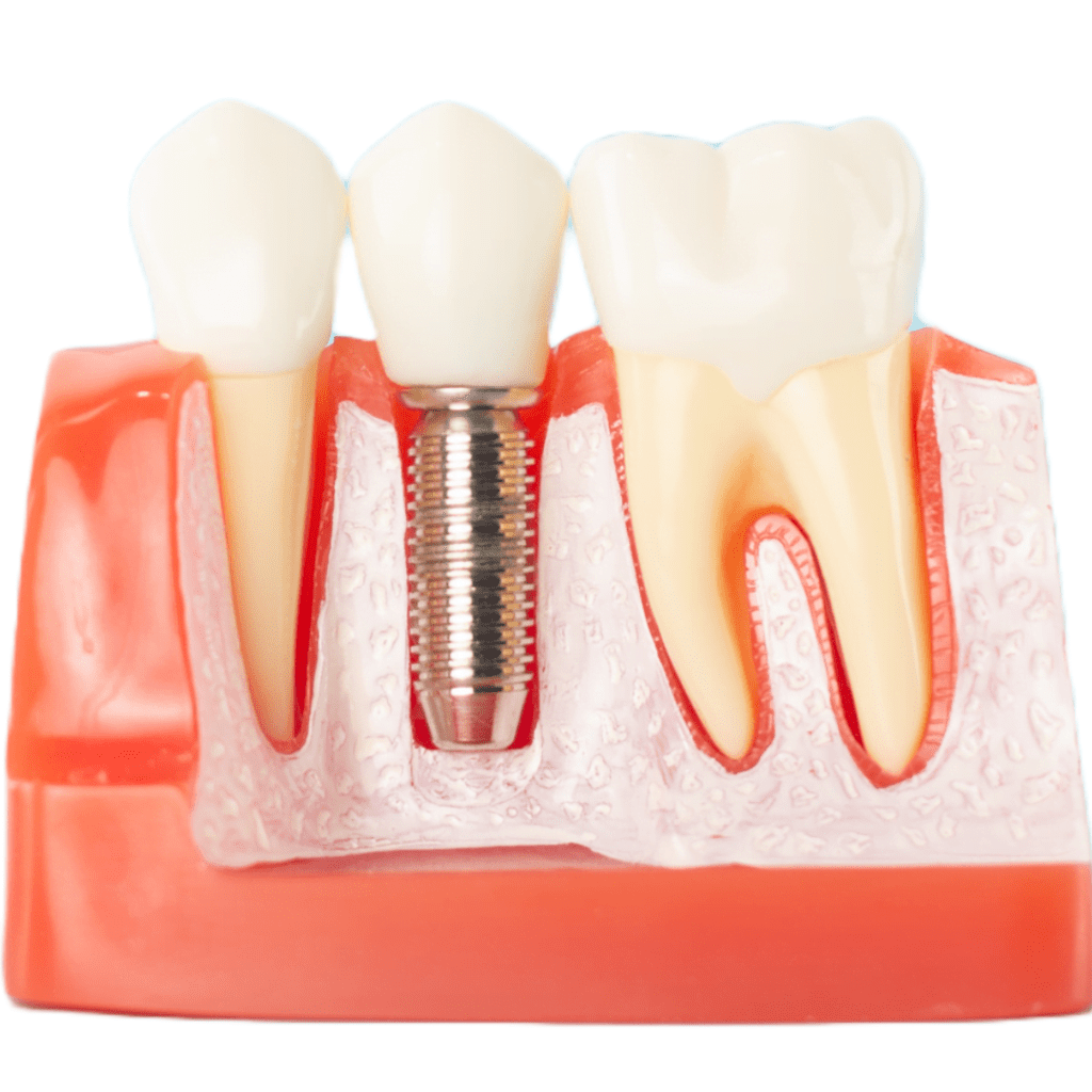 Exploring Dental Implant Failures: Causes, Prevention, and Treatment ...