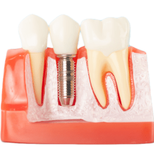 A dental implant 